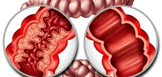 Eficacia y seguridad de las células madre mesenquimales derivadas del cordón umbilical alogénico para el tratamiento de la fístula perianal compleja en la enfermedad de Crohn: un estudio piloto